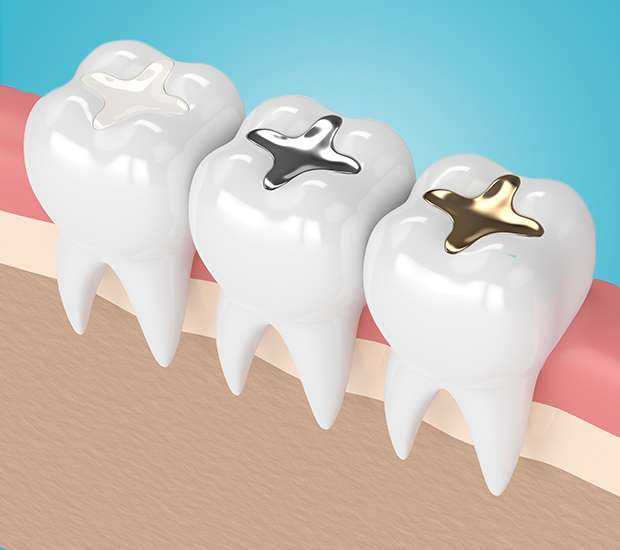 Oklahoma City Composite Fillings