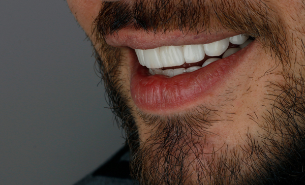 Benefits Of Getting A Professional Dental Cleaning