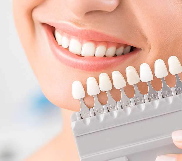 Oklahoma City Dental Veneers and Dental Laminates