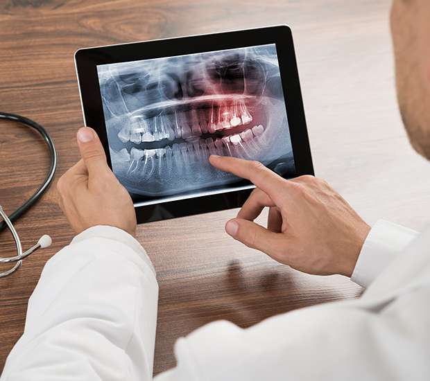 Oklahoma City Types of Dental Root Fractures