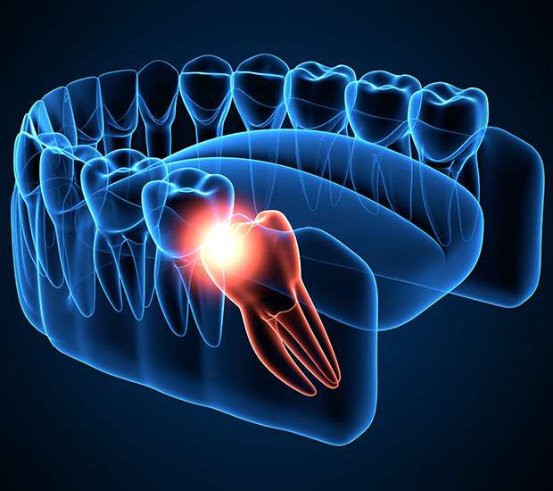 Oklahoma City Wisdom Teeth Extraction